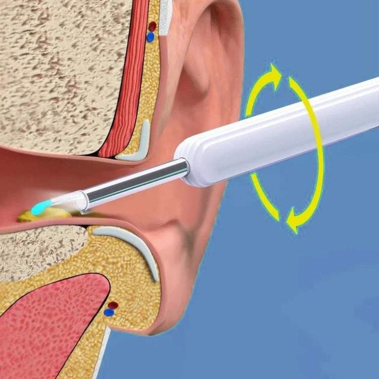 EarScope Pro Wax Removal Kit
